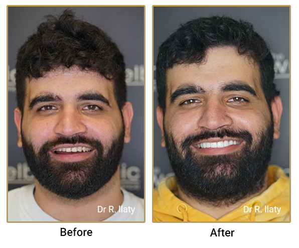 Before After